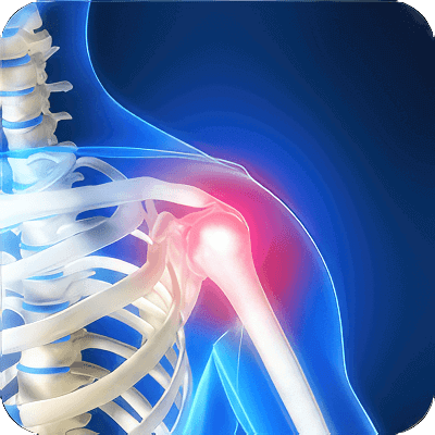 computerized x-ray image of a shoulder