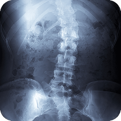 x-ray image of a spine with scoliosis