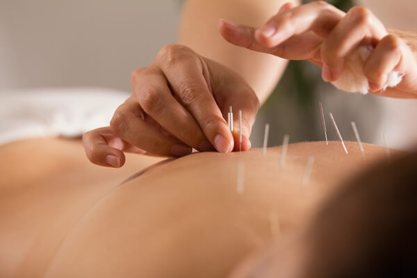 Acupuncture